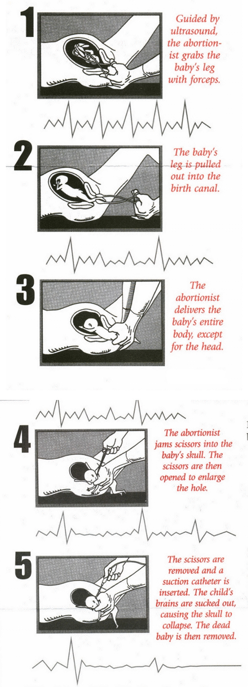 The Steps to performing an abortion.